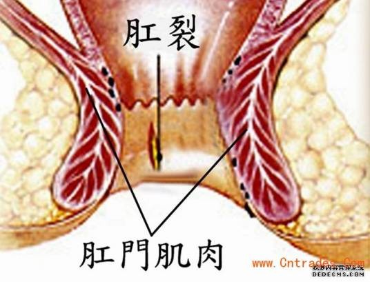 女性肛裂