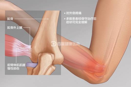 网球肘