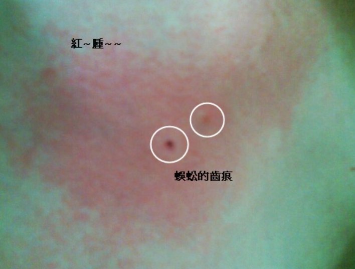被草鞋底子咬后什么样？