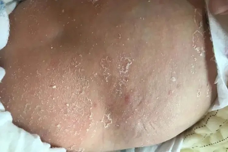亚急性湿疹腹部脱皮图片