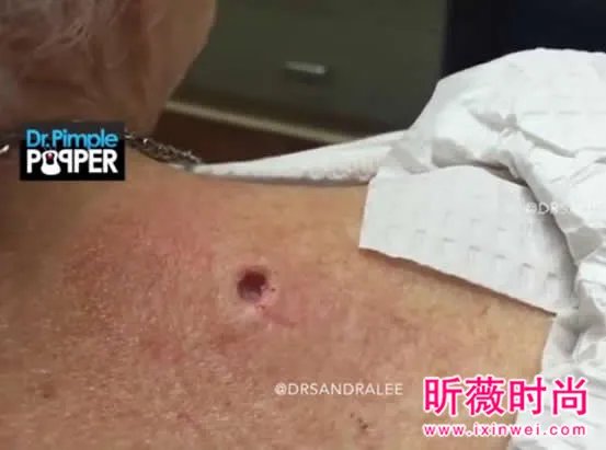 3年黑头被拔出 过程太吓人(图)