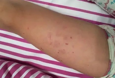 多名孩子身上出现针眼,为何作为老师都如此狠心?