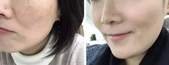 面部激光除皱怎么样,皮秒多久做一次?