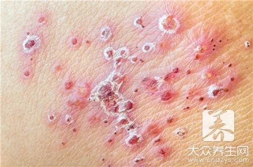 丘疹性荨麻疹偏方