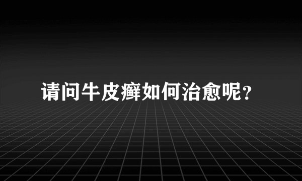 请问牛皮癣如何治愈呢？