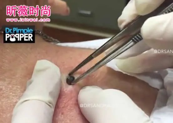 3年黑头被拔出 过程太吓人(图)