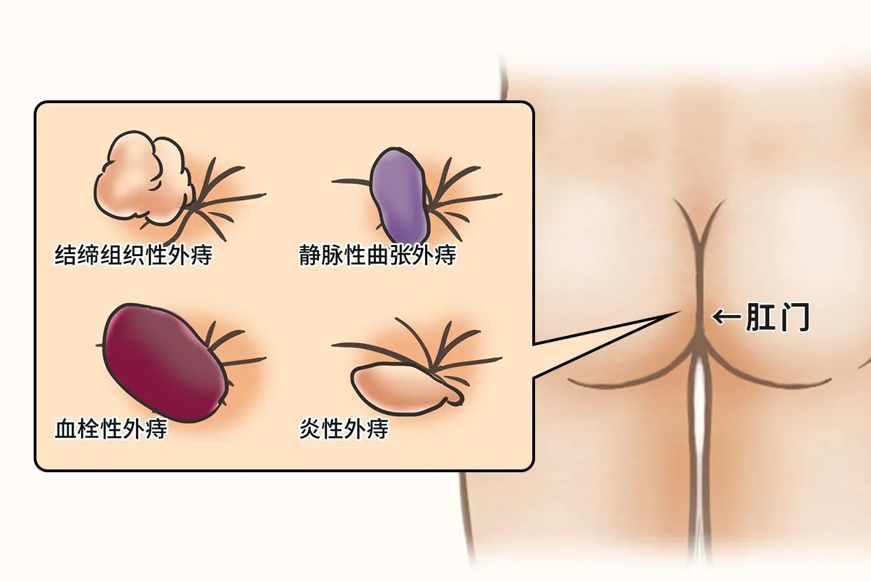 轻度痔疮图片大全