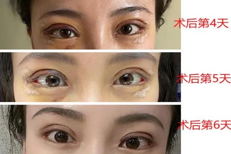 割双眼皮一到七天图片