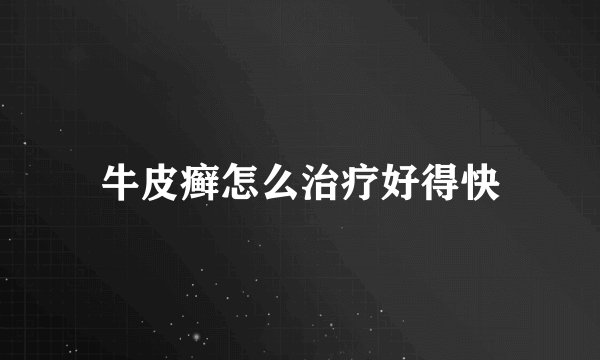 牛皮癣怎么治疗好得快