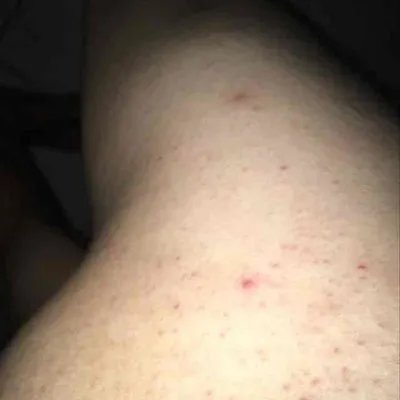 激素皮炎症状?