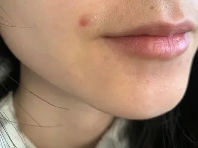 交界痣口周症状图片