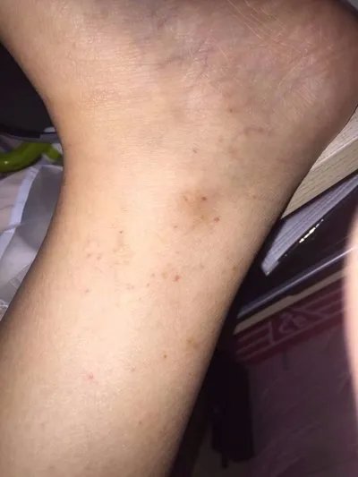 激素皮炎症状?