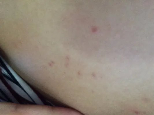 激素皮炎症状?