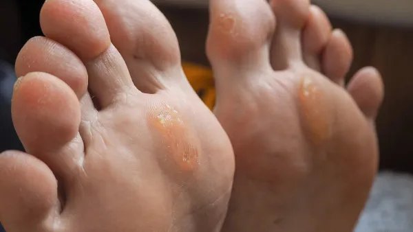 鸡眼是什么样子