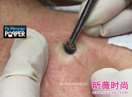 3年黑头被拔出 过程太吓人(图)
